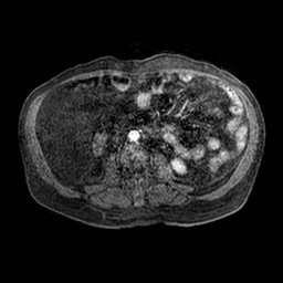 File:Cirrhosis and hepatocellular carcinoma in the setting of hemochromatosis (Radiopaedia 75394-86594 Axial T1 C+ fat sat 89).jpg