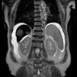 File:Cirrhosis and hepatocellular carcinoma in the setting of hemochromatosis (Radiopaedia 75394-86594 Coronal T2 22).jpg