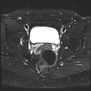File:Class II Mullerian duct anomaly- unicornuate uterus with rudimentary horn and non-communicating cavity (Radiopaedia 39441-41755 Axial T2 fat sat 20).jpg