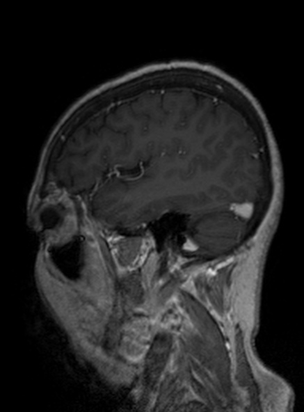 Clival meningioma (Radiopaedia 53278-59248 Sagittal T1 C+ 176).jpg