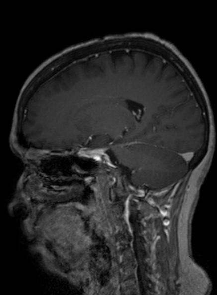 Clival meningioma (Radiopaedia 53278-59248 Sagittal T1 C+ 227).jpg