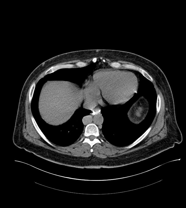 Closed-loop small bowel obstruction-internal hernia (Radiopaedia 78439-91096 Axial non-contrast 15).jpg
