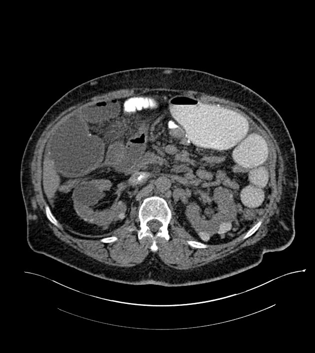 Closed-loop small bowel obstruction-internal hernia (Radiopaedia 78439-91096 Axial non-contrast 60).jpg