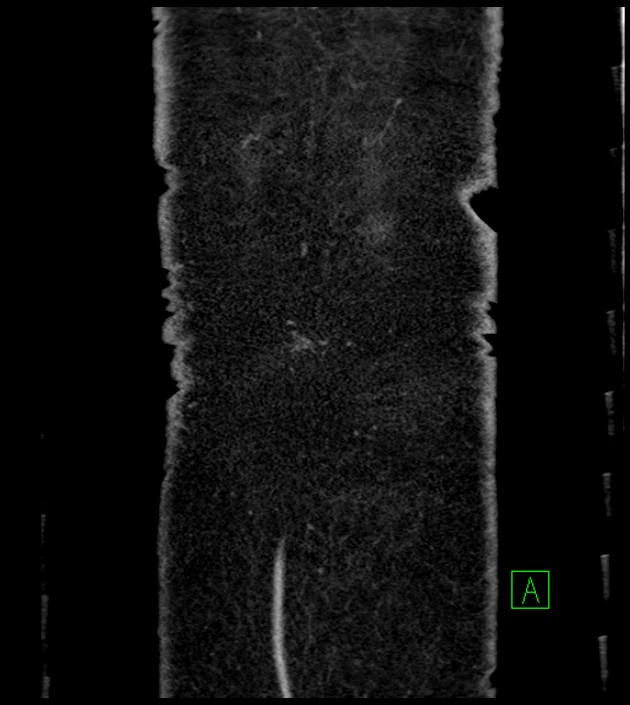 Closed-loop small bowel obstruction-internal hernia (Radiopaedia 78439-91096 Coronal non-contrast 102).jpg