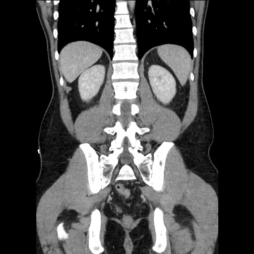 Closed-loop small bowel obstruction (Radiopaedia 73713-84509 C 91).jpg