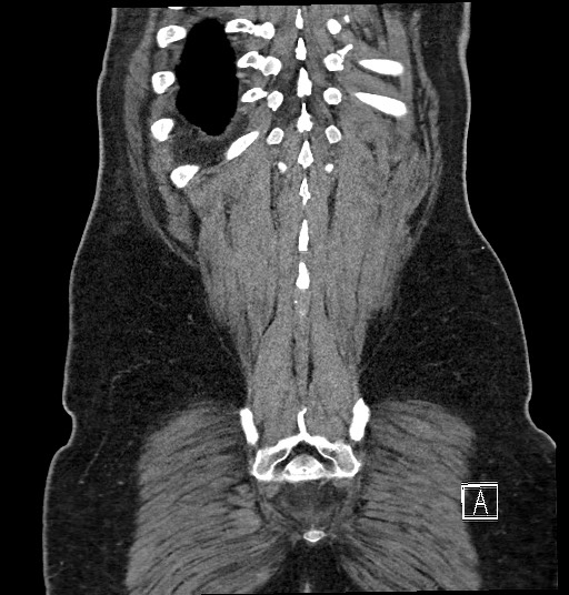 File:Closed loop obstruction - internal hernia into nephrectomy bed (Radiopaedia 59867-67320 B 129).jpg