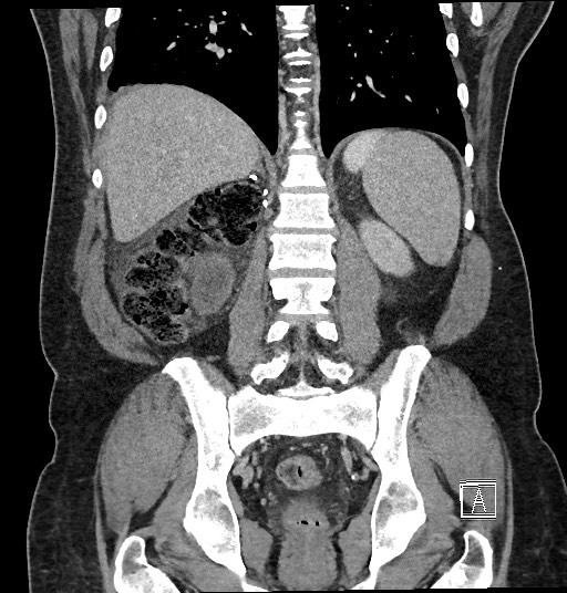 Closed loop obstruction - internal hernia into nephrectomy bed (Radiopaedia 59867-67320 B 98).jpg