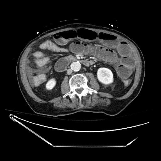 File:Closed loop obstruction due to adhesive band, resulting in small bowel ischemia and resection (Radiopaedia 83835-99023 Axial 409).jpg
