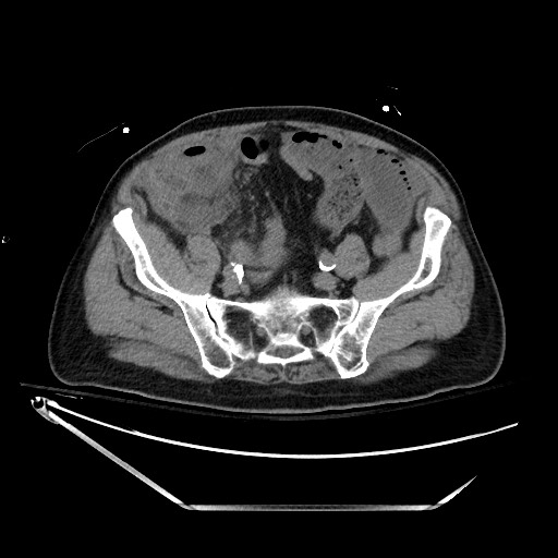 Closed loop obstruction due to adhesive band, resulting in small bowel ischemia and resection (Radiopaedia 83835-99023 Axial non-contrast 114).jpg