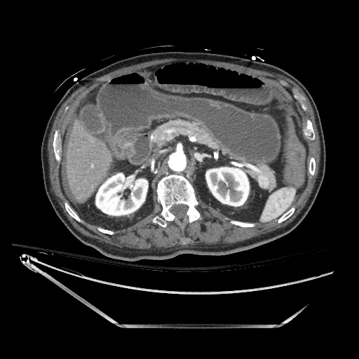 Closed loop obstruction due to adhesive band, resulting in small bowel ischemia and resection (Radiopaedia 83835-99023 B 52).jpg