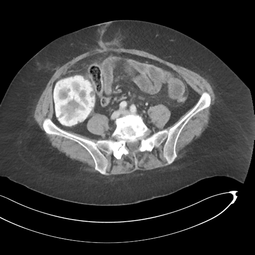 Closed loop small bowel obstruction (Radiopaedia 58281-65391 A 57).png