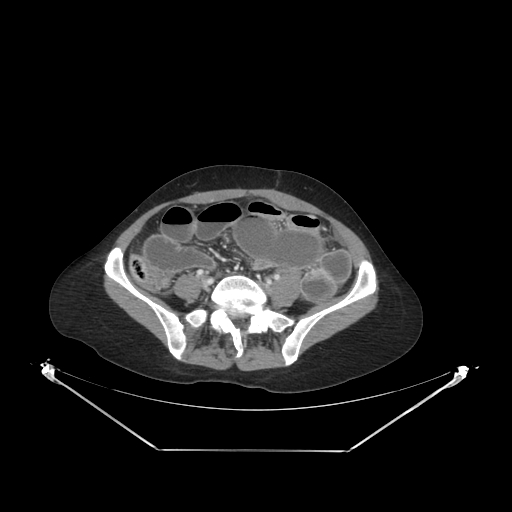 Closed loop small bowel obstruction (Radiopaedia 68471-78022 A 43).jpg