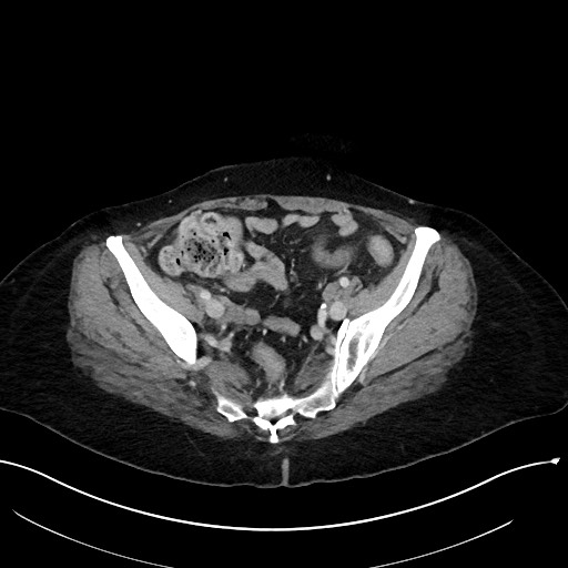 File:Closed loop small bowel obstruction - adhesions (Radiopaedia 59078-66369 A 103).jpg