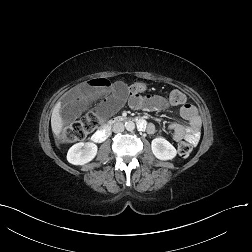 File:Closed loop small bowel obstruction - adhesions (Radiopaedia 59078-66369 A 58).jpg