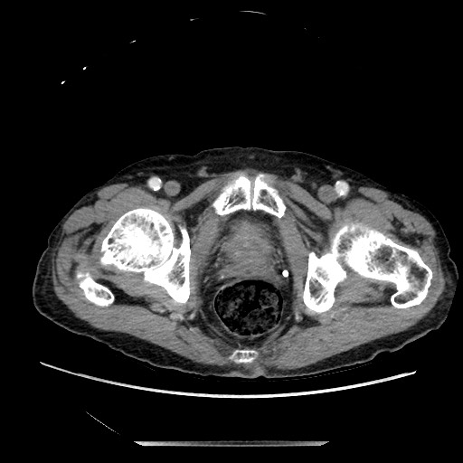Closed loop small bowel obstruction - adhesive disease and hemorrhagic ischemia (Radiopaedia 86831-102990 A 173).jpg