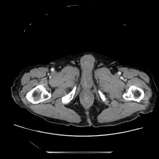 Closed loop small bowel obstruction - adhesive disease and hemorrhagic ischemia (Radiopaedia 86831-102990 A 192).jpg