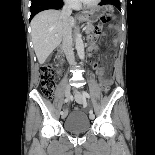 File:Closed loop small bowel obstruction - omental adhesion causing "internal hernia" (Radiopaedia 85129-100682 B 66).jpg
