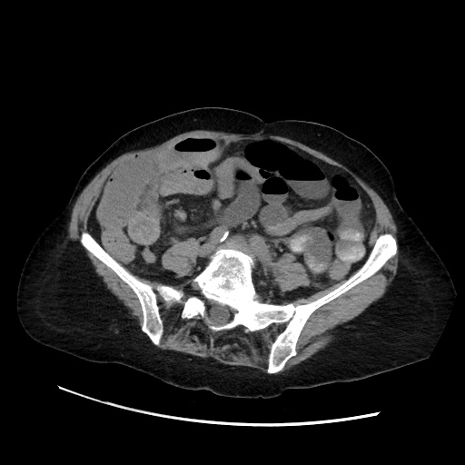 Closed loop small bowel obstruction due to adhesive band, with intramural hemorrhage and ischemia (Radiopaedia 83831-99017 Axial non-contrast 103).jpg