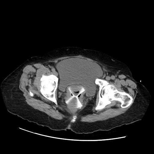 Closed loop small bowel obstruction due to adhesive band, with intramural hemorrhage and ischemia (Radiopaedia 83831-99017 Axial non-contrast 148).jpg