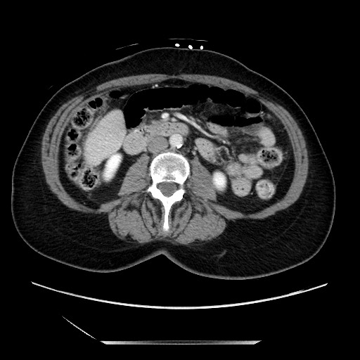 File:Closed loop small bowel obstruction due to adhesive bands - early and late images (Radiopaedia 83830-99014 A 69).jpg