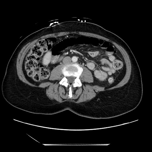 File:Closed loop small bowel obstruction due to adhesive bands - early and late images (Radiopaedia 83830-99014 A 76).jpg