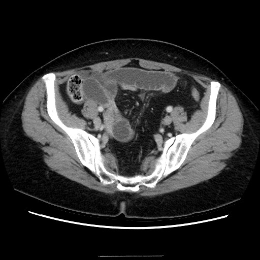Closed loop small bowel obstruction due to adhesive bands - early and late images (Radiopaedia 83830-99015 A 130).jpg