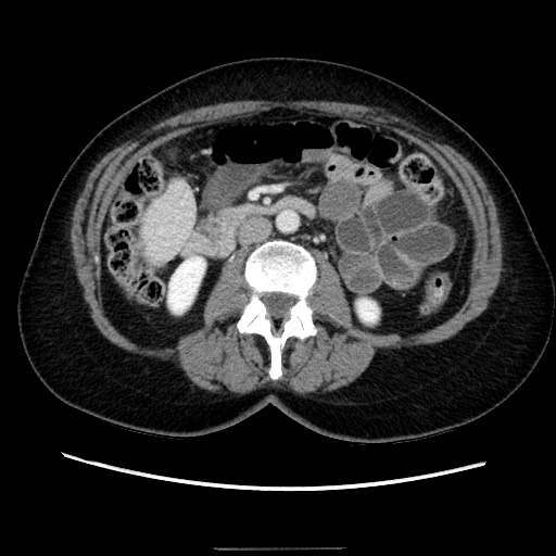 Closed loop small bowel obstruction due to adhesive bands - early and late images (Radiopaedia 83830-99015 A 74).jpg