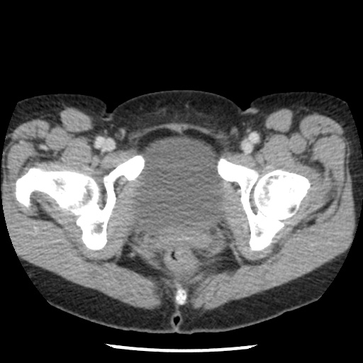 Closed loop small bowel obstruction due to trans-omental herniation (Radiopaedia 35593-37109 A 84).jpg