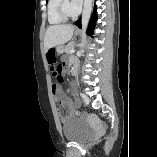 File:Closed loop small bowel obstruction due to trans-omental herniation (Radiopaedia 35593-37109 C 38).jpg