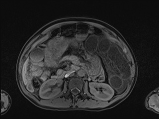 Closed loop small bowel obstruction in pregnancy (MRI) (Radiopaedia 87637-104031 Axial T1 fat sat 51).jpg