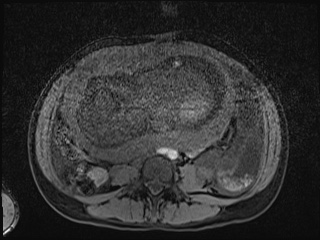 Closed loop small bowel obstruction in pregnancy (MRI) (Radiopaedia 87637-104031 F 11).jpg