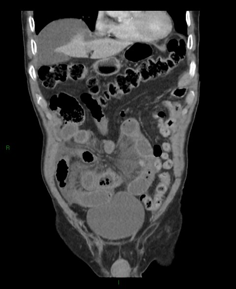 Closed loop small bowel obstruction with ischemia (Radiopaedia 84180-99456 B 50).jpg