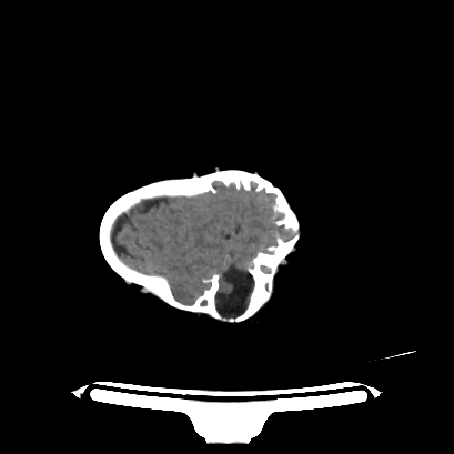 Cloverleaf skull (Radiopaedia 91901-109710 Axial non-contrast 130).jpg