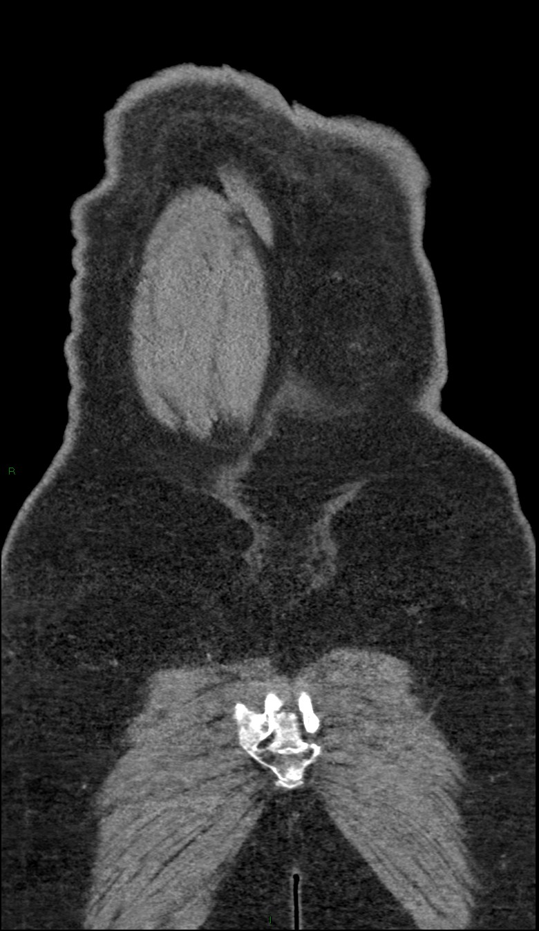 Coarctation of the aorta (Radiopaedia 74632-88521 B 256).jpg
