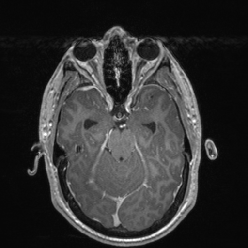 File:Colloid cyst (Radiopaedia 44510-48181 Axial T1 C+ 69).png