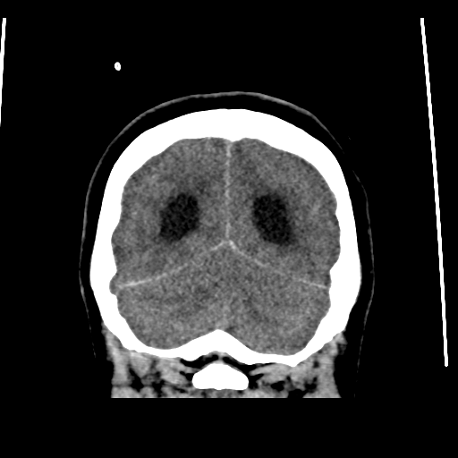 Colloid cyst (resulting in death) (Radiopaedia 33423-34469 Coronal non-contrast 46).png