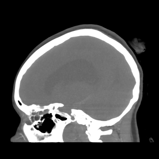 File:Colloid cyst (resulting in death) (Radiopaedia 33423-34499 B 34).png