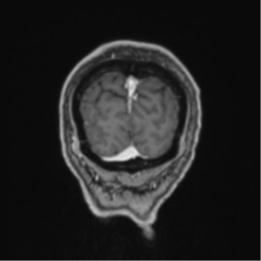 Colloid cyst of the third ventricle (Radiopaedia 86571-102662 Coronal T1 C+ 11).png