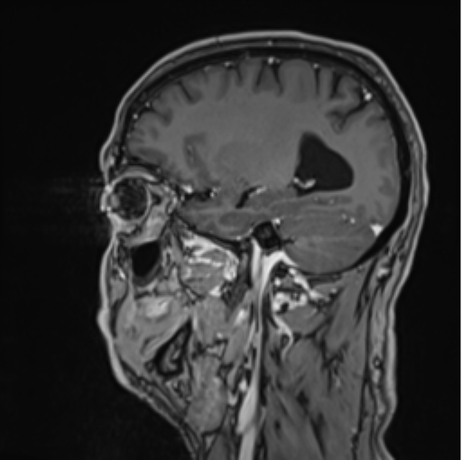 Colloid cyst of the third ventricle (Radiopaedia 86571-102662 Sagittal T1 C+ 24).png