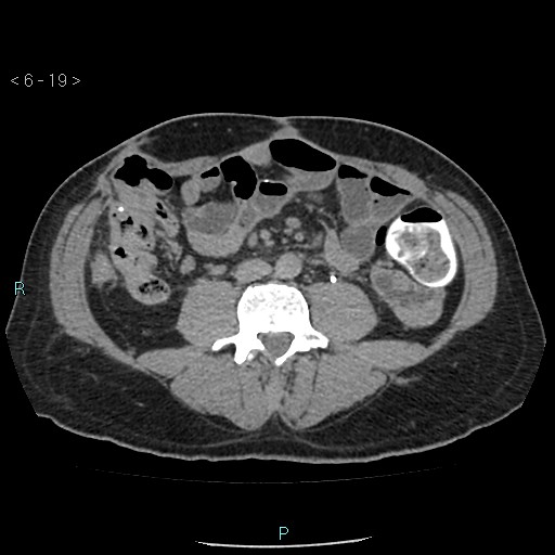 File:Colo-cutaneous fistula (Radiopaedia 40531-43129 A 7).jpg