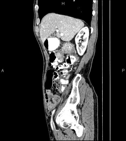 Colon adenocarcinoma - hepatic flexure (Radiopaedia 85635-101395 D 23).jpg