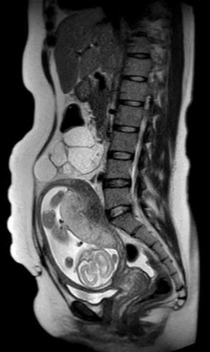 Colon adenocarcinoma with Krukenberg tumors, advanced pregnancy (Radiopaedia 67279-76645 Sagittal T2 28).jpg