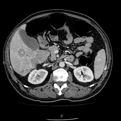 Colon adenocarcinoma with calcific liver metastasis (Radiopaedia 55745-62300 B 15).jpg