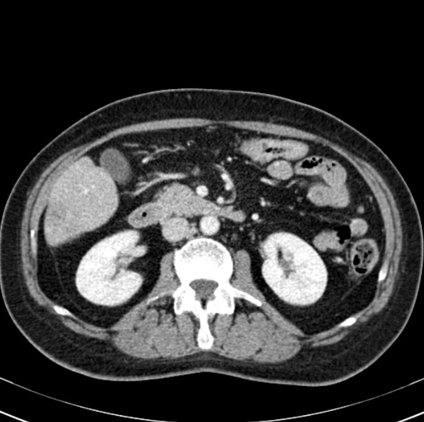 Colon carcinoma with hepatic metastases (Radiopaedia 29477-29961 A 49).jpg