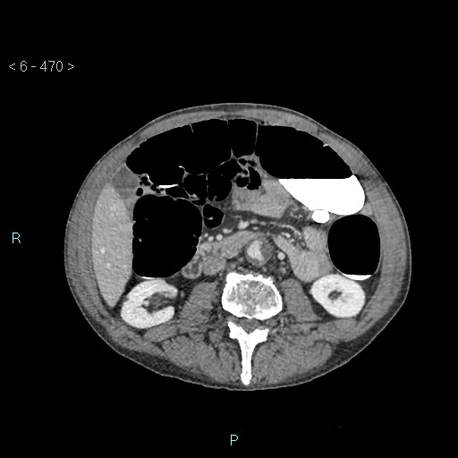 File:Colonic cancer (ultrasound and TC imaging) (Radiopaedia 50346-55713 A 54).jpg