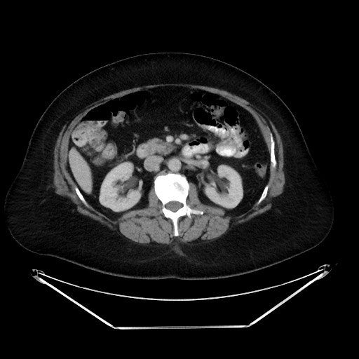 File:Colonic intussusception due to adenocarcinoma (Radiopaedia 86828-102987 A 63).jpg