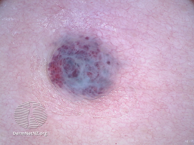 File:Dermoscopy of angiokeratoma of Fordyce on vulva (DermNet NZ angiokeratoma-46).jpg