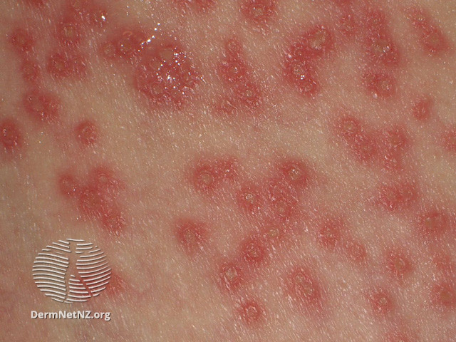 File:Eczema herpeticum (DermNet NZ viral-eczema-herpticum17).jpg