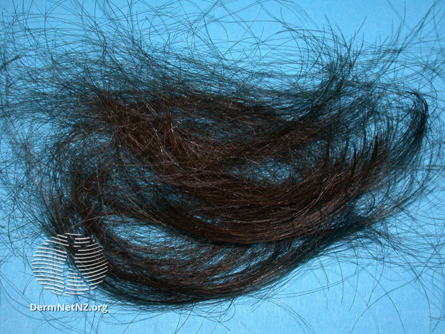 File:Hair lost through chemotherapy (DermNet NZ hair-nails-sweat-anagen-hair).jpg