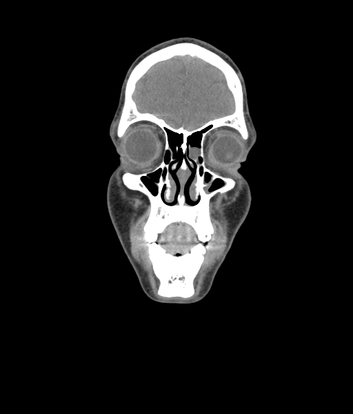 Nasal pyogenic granuloma (lobular capillary hemangioma) (Radiopaedia 85536-101244 Coronal non-contrast 60).jpg